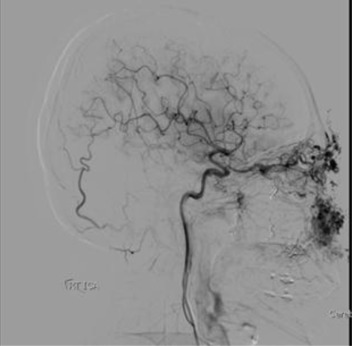 One-year follow-up angiogram showing residual arteriovenous malformation.