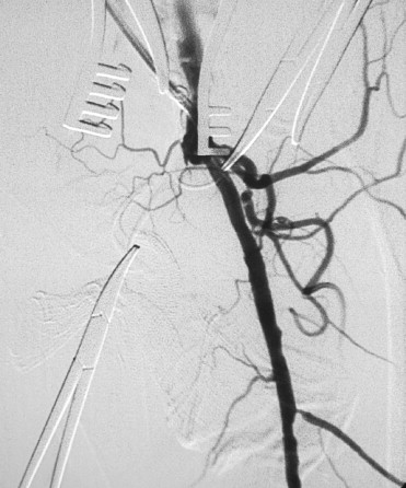 The condition of the ostium of the superficial femoral artery confirmed by the ...