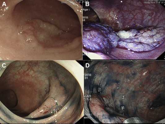 (A) Homogeneous and (B) nodular mixed subtypes of granular laterally spreading ...