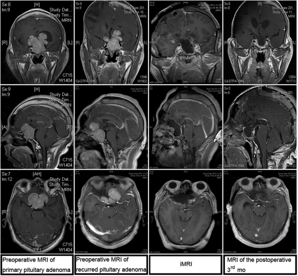 Resection of a recurred large invasive pituitary adenoma under the assistance of ...