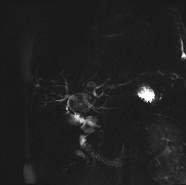 Magnetic resonance cholangiopancreatography showing the dilated hepatic duct ...