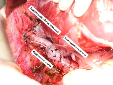 Side-to-side anastomosis connecting the graft retrohepatic IVC and the recipient ...