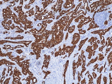 Tumor adenomatoide paratesticular – marcação imuno‐histoquímica positiva para ...