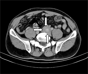 Infiltrate soft tissue around the left common iliac artery (arrows).