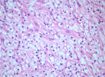 Histology of the resected renal cell carcinoma showing the characteristic ...