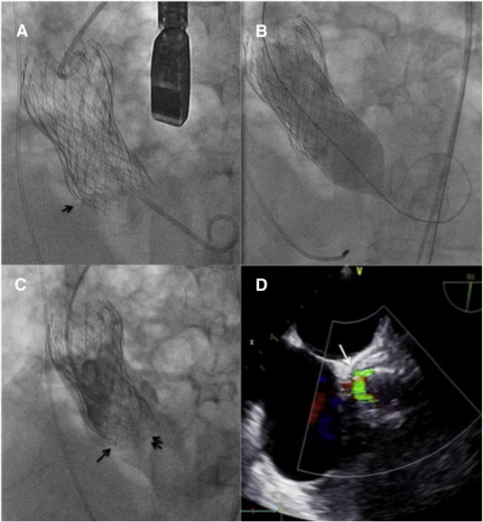 (A) Second TAV implanted below the previous one. We can observe that the lower ...