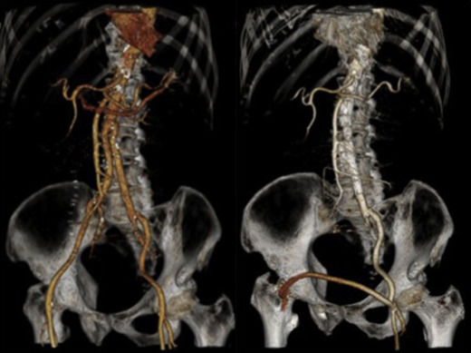 Late intervention, Patient 1.