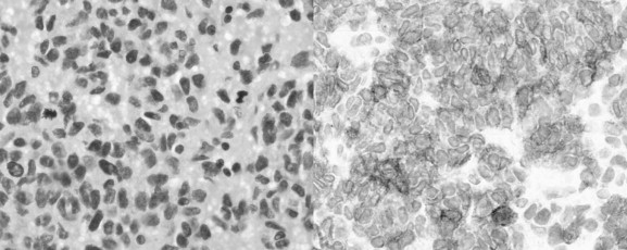 (Left) Hematoxylin and eosin staining of the tumor and (Right) positive ...