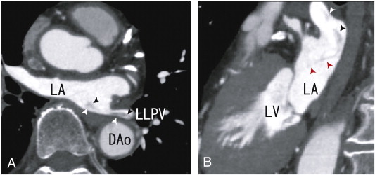 A. 64-MDCT axial images demonstrating a thrombus from the left lower pulmonary ...