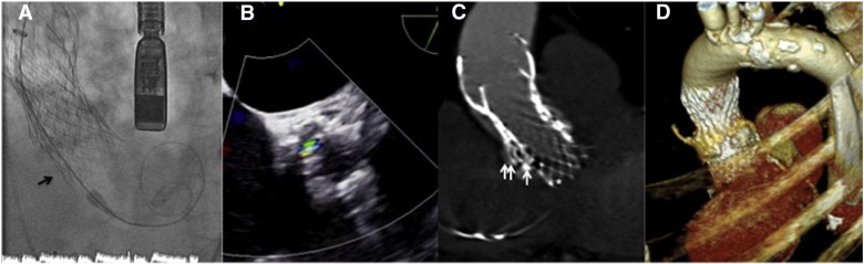 (A) Implant of third TAV far below the previous ones (arrow). (B) Only traces of ...