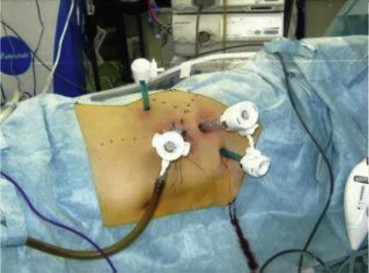 Placement of trocars for conventional transperitoneal laparoscopic right ...