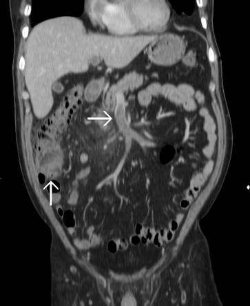 The upward arrow indicates cecal diverticulitis and the rightward arrow ...