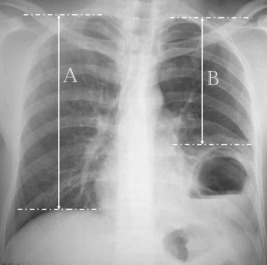 Preoperative chest X-ray.