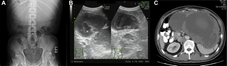 (A) Kidney, Ureter, Bladder (KUB) X ray found increased soft tissue density over ...