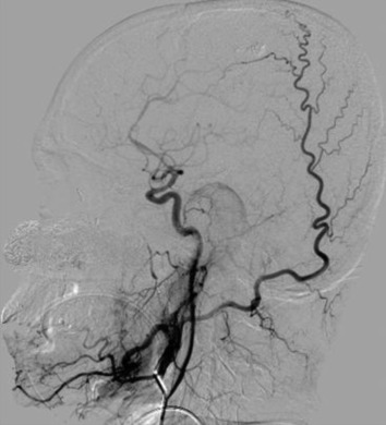 Bulk of the previously large arteriovenous malformation not visible after the ...