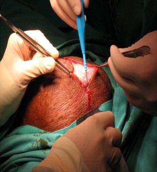 Paramedian scrotal incision (2–2.5 cm).