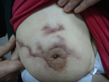 The picture presents the deformation of the breast due to skin fistulas of IGM. ...