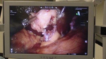Clipping of the cystic artery and the cystic duct.