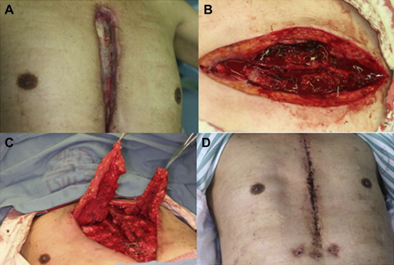(A) Man (66 years old) presented with chest wound infection 5 months after CABG. ...