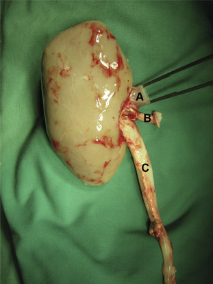 Explanted kidney after a 30-hour cold ischemia time [(A) renal vein; (B) renal ...