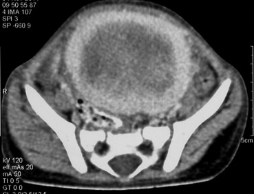 Contrast-enhanced computed tomography scan shows a hypodense lesion with ...