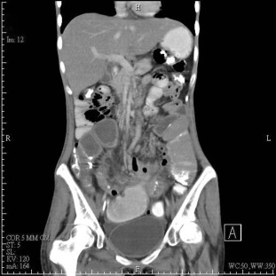 Abdominal computed tomography demonstrates significant dilatation of distal ...