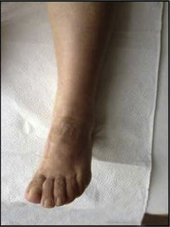 Foot and ankle of the patient at the end of the 1st year follow-up.