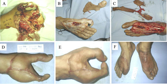 Total hand degloving injury (Case 2). (A) Before surgery. (B and C) Incised flap ...