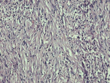 Histological findings (200×) show proliferation of spindle-shaped cells with ...