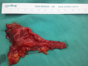 After excision, measured saphenous venous diameter was 7 cm × 4 cm.
