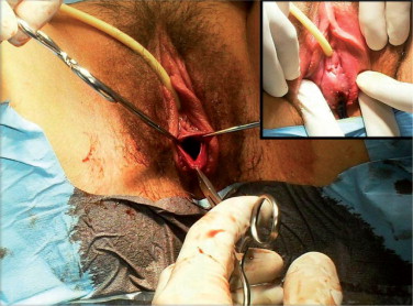 Tratamento cirúrgico de hímen imperfurado (sangue viscoso, castanho tipo ...