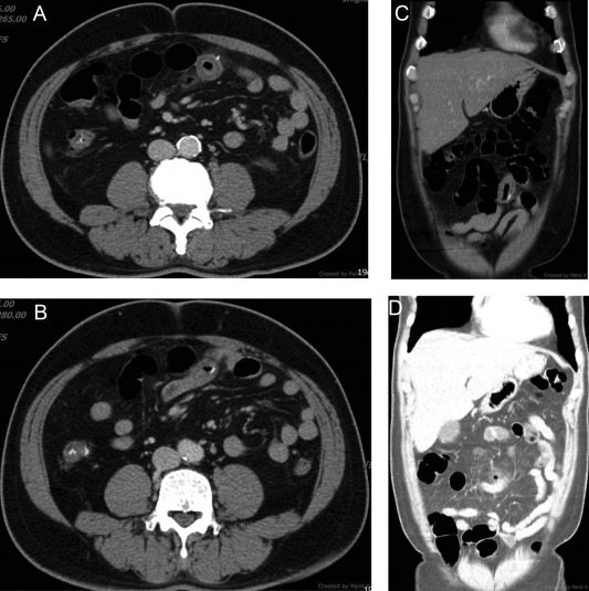 Multidetector computed tomography of the abdomen. (A, B) Axial images ...
