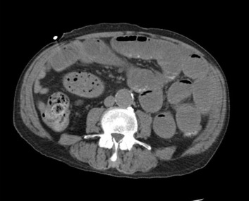 Computed–tomography scan image demonstrating high grade small bowel obstruction.
