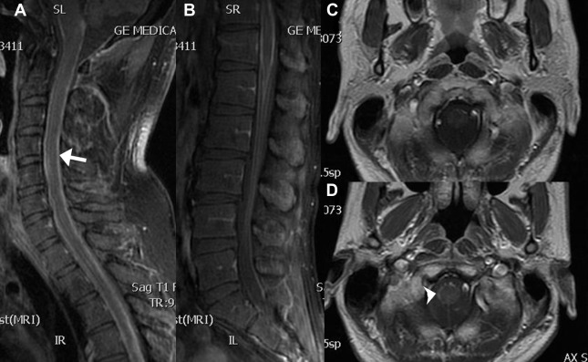 Postcontrast T1-weighted MR images of the cervical (A) and lumbar spine (B) ...
