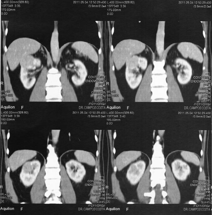Resultados da tomografia axial computorizada abdominal com contraste (cortes ...