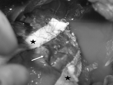 The left ventricle after resection of the pseudoaneurysm (white arrow), repaired ...