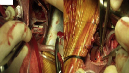 Atrial septal defect (arrows) and the defect that will be closed with a patch ...
