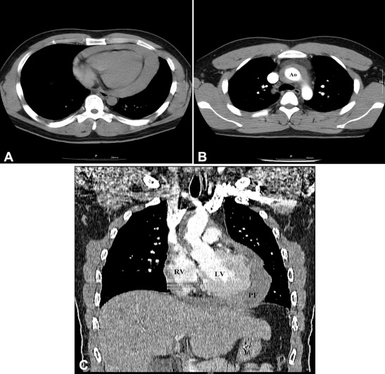 Chest computed tomography findings. (A) Unenhanced scan shows large pericardial ...