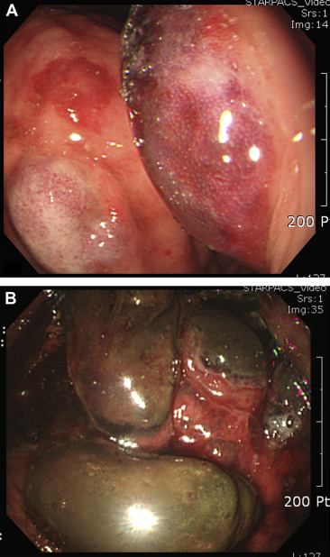 (A) Initial gastroscopy indicated a very large submucosal hematoma from the ...