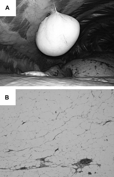 (A) The pedunculated tumor was found to protrude into the thoracic cavity from ...