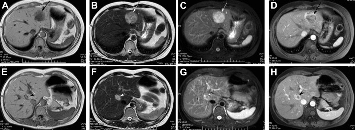 MR image of multiple hepatic perivascular epithelioid cell tumors in a ...