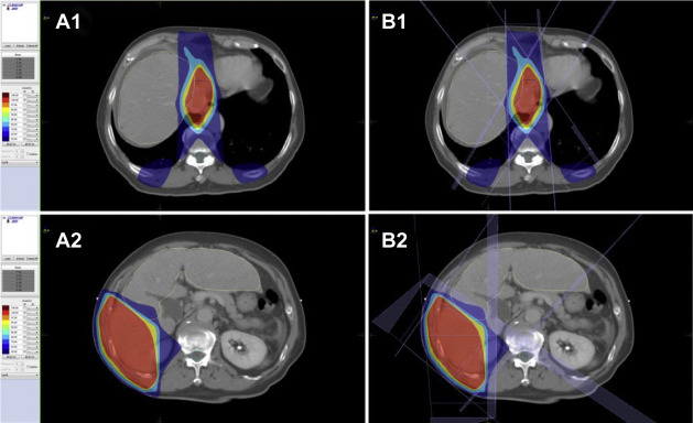 Computed tomography scans of our patient with hepatocellular carcinoma showing ...