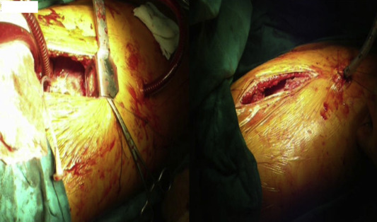 In patients who had right vertical infra-axillar thoracotomy (RVIAT), inferior ...