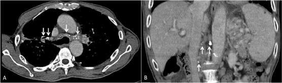 Computed tomography (CT) scan images. (A) Chest CT scan showed partially ...