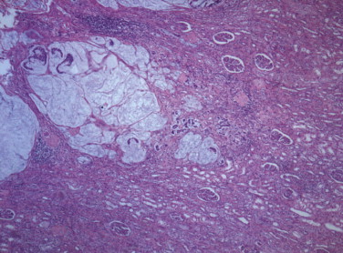 Infiltration of the renal parenchyma by mucinous adenocarcinoma. ...