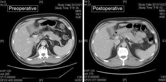 Pre- and postoperative (at 19 months) computed tomography images of a single ...