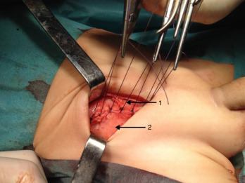 1) Aponevrose do músculo grande oblíquo; 2) bainha do músculo reto abdominal.