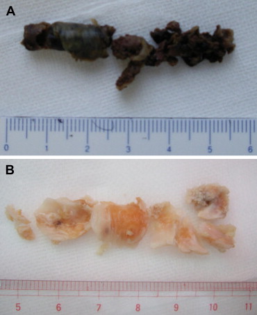 (A) A soft old thrombus that was removed from the superficial femoral artery ...