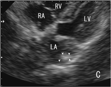 Images of transthoracic echocardiography (TTE). The thrombus in the left atrium ...