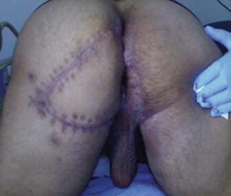 Post-operative result after excision.